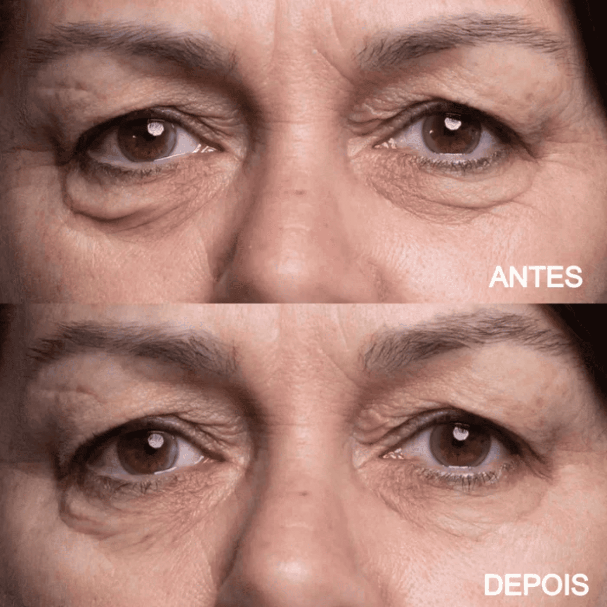 Adesivo Anti-Rugas Olhos